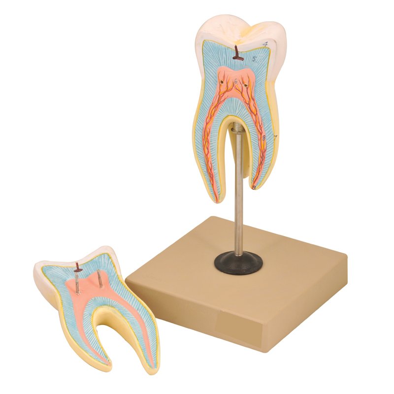 Coupe d’une Molaire avec carie