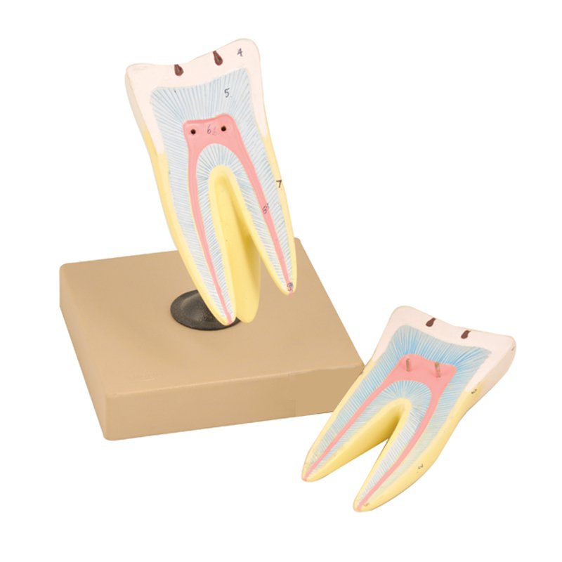 Coupe d’une Molaire avec Caries